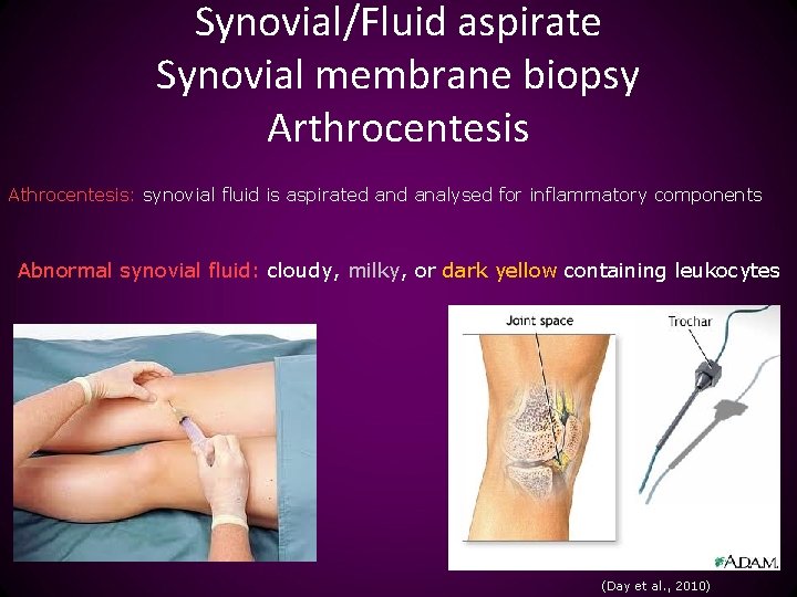 Synovial/Fluid aspirate Synovial membrane biopsy Arthrocentesis Athrocentesis: synovial fluid is aspirated analysed for inflammatory