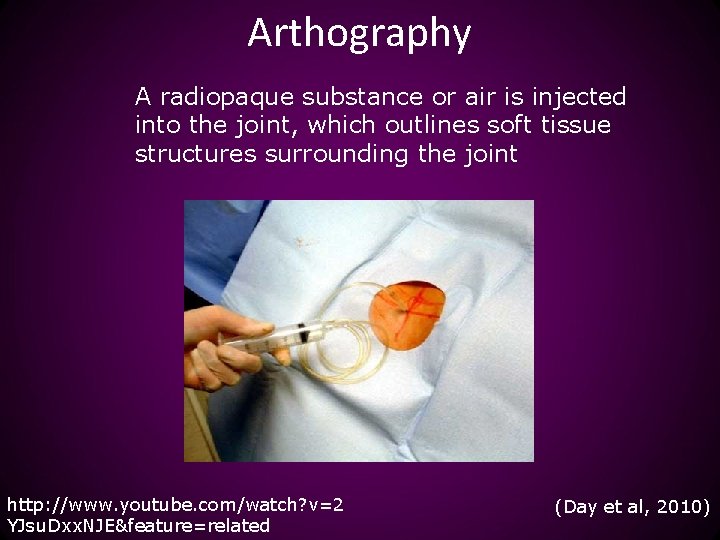 Arthography A radiopaque substance or air is injected into the joint, which outlines soft