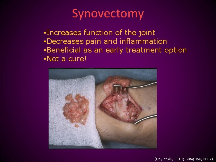 Synovectomy • Increases function of the joint • Decreases pain and inflammation • Beneficial