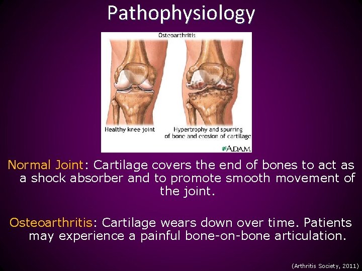 Pathophysiology Normal Joint: Cartilage covers the end of bones to act as a shock