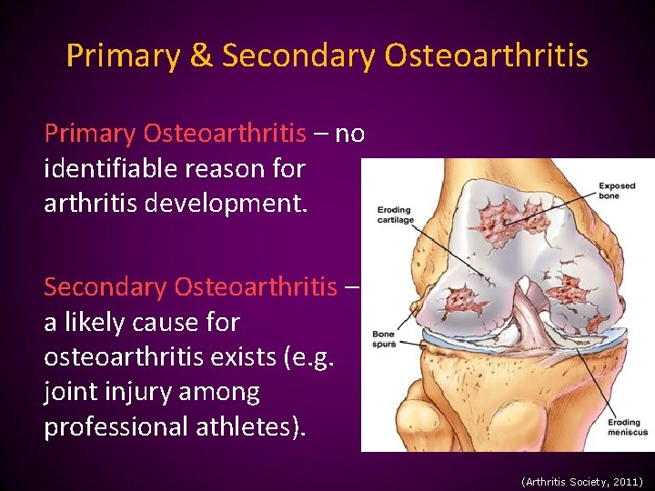 Primary & Secondary Osteoarthritis Primary Osteoarthritis – no identifiable reason for arthritis development. Secondary