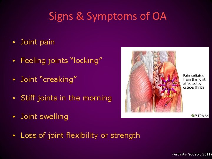 Signs & Symptoms of OA • Joint pain • Feeling joints “locking” • Joint