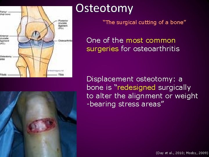 Osteotomy “The surgical cutting of a bone” One of the most common surgeries for