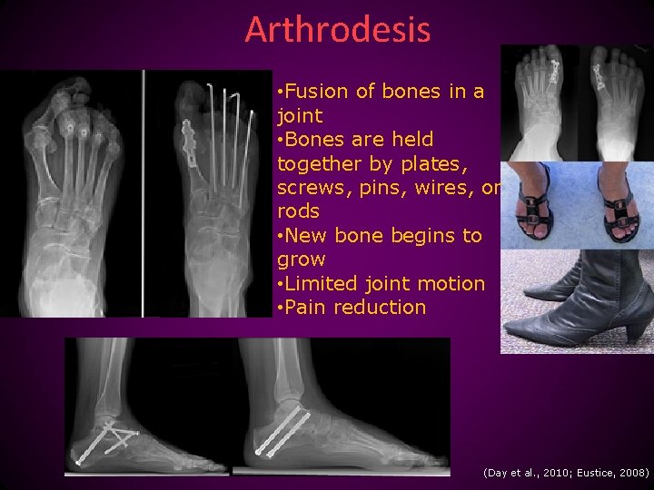 Arthrodesis • Fusion of bones in a joint • Bones are held together by