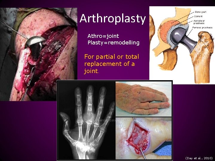 Arthroplasty Athro=joint Plasty=remodelling For partial or total replacement of a joint. (Day et al.