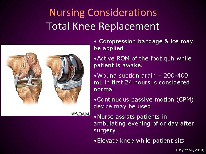 Nursing Considerations Total Knee Replacement • Compression bandage & ice may be applied •