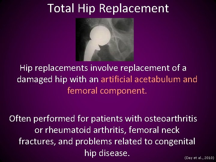 Total Hip Replacement Hip replacements involve replacement of a damaged hip with an artificial