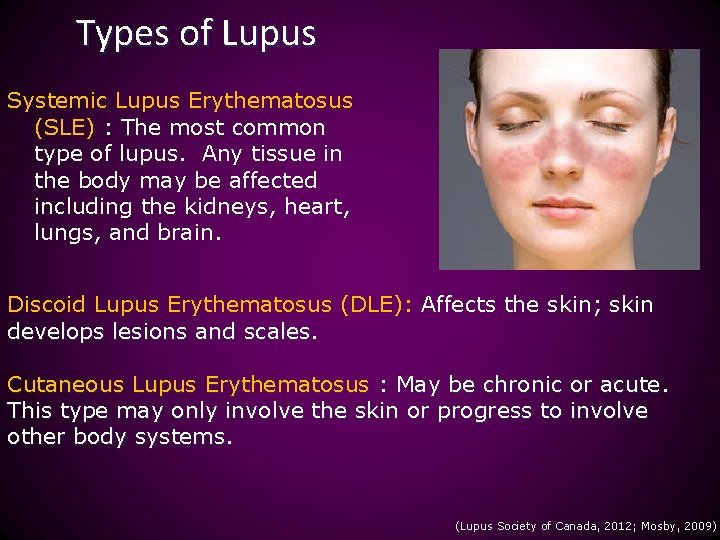 Types of Lupus Systemic Lupus Erythematosus (SLE) : The most common type of lupus.