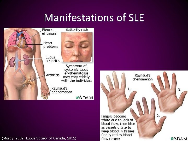 Manifestations of SLE (Mosby, 2009; Lupus Society of Canada, 2012) 