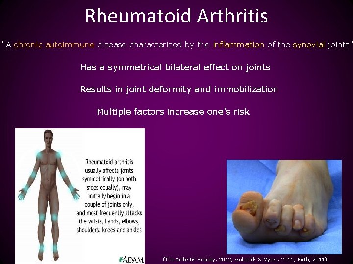 Rheumatoid Arthritis “A chronic autoimmune disease characterized by the inflammation of the synovial joints”