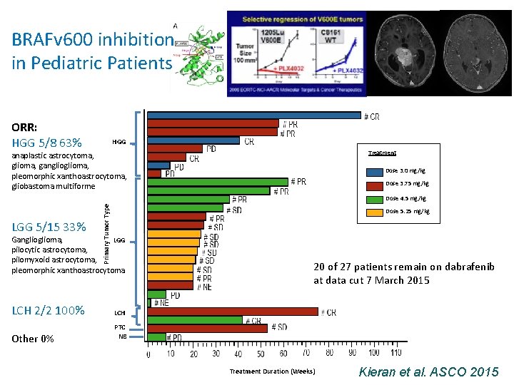 BRAFv 600 inhibition in Pediatric Patients ORR: HGG 5/8 63% HGG Treatment anaplastic astrocytoma,