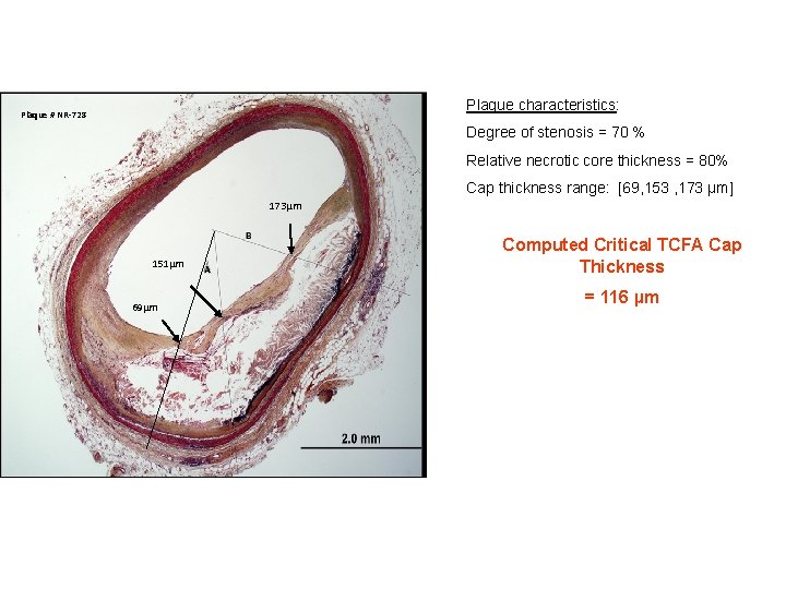 Plaque characteristics: Plaque # NR-728 Degree of stenosis = 70 % Relative necrotic core