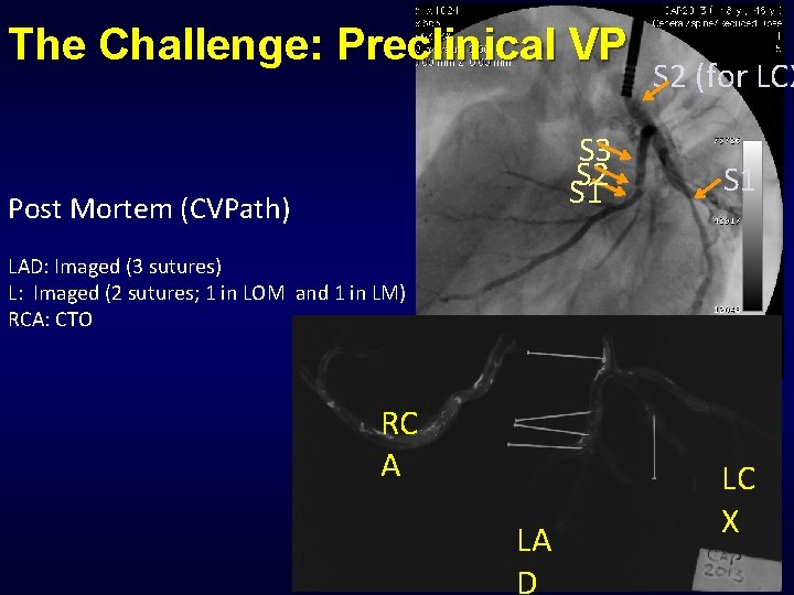 The Challenge: Preclinical VP S 3 S 2 S 1 Post Mortem (CVPath) S