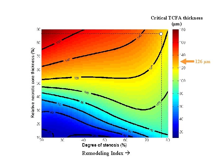 Critical TCFA thickness (µm) 126 µm Remodeling Index 