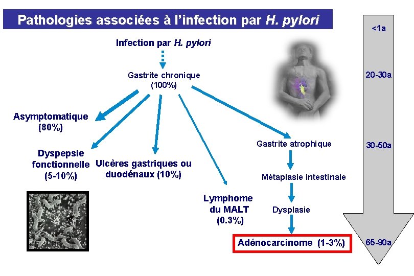 Pathologies associées à l’infection par H. pylori <1 a Infection par H. pylori 20