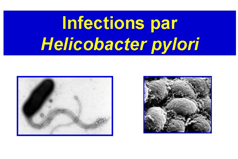 Infections par Helicobacter pylori 