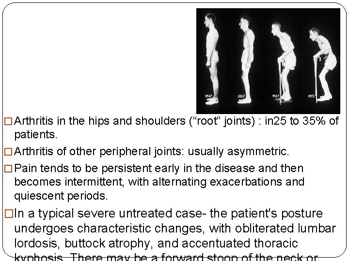 � Arthritis in the hips and shoulders (“root” joints) : in 25 to 35%