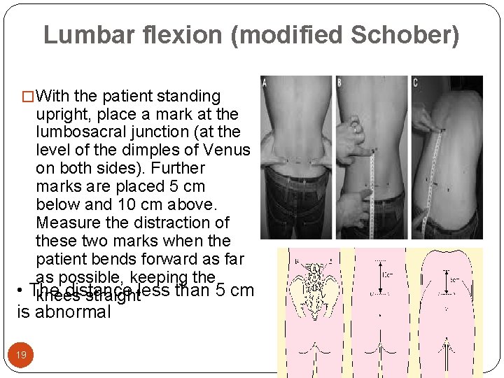 Lumbar flexion (modified Schober) � With the patient standing upright, place a mark at