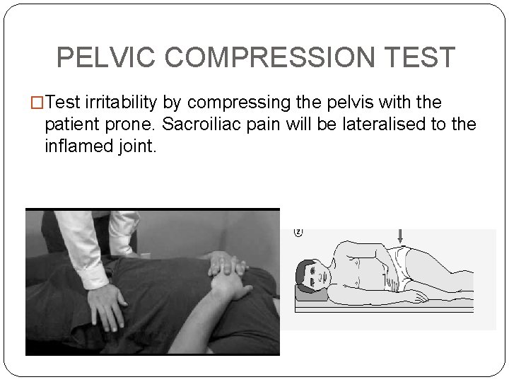 PELVIC COMPRESSION TEST �Test irritability by compressing the pelvis with the patient prone. Sacroiliac