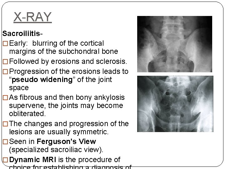 X-RAY Sacroiliitis- � Early: blurring of the cortical margins of the subchondral bone �