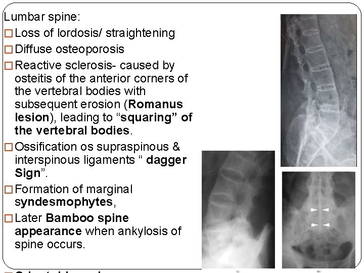 Lumbar spine: � Loss of lordosis/ straightening � Diffuse osteoporosis � Reactive sclerosis- caused