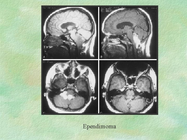 Ependimoma 