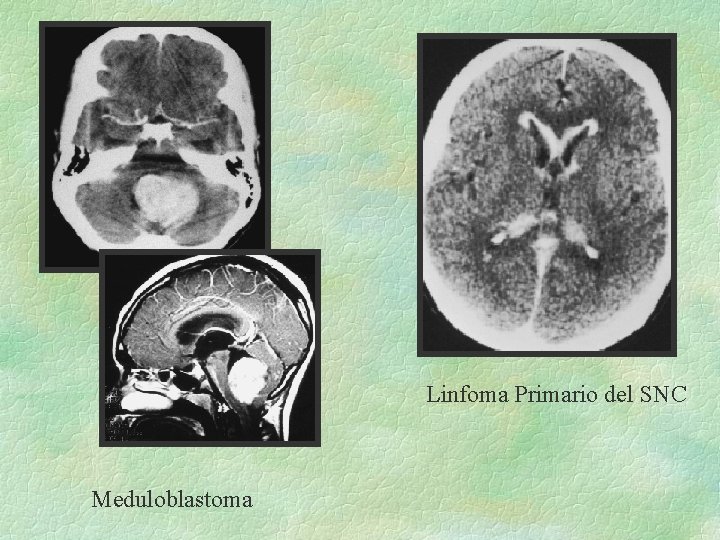Linfoma Primario del SNC Meduloblastoma 
