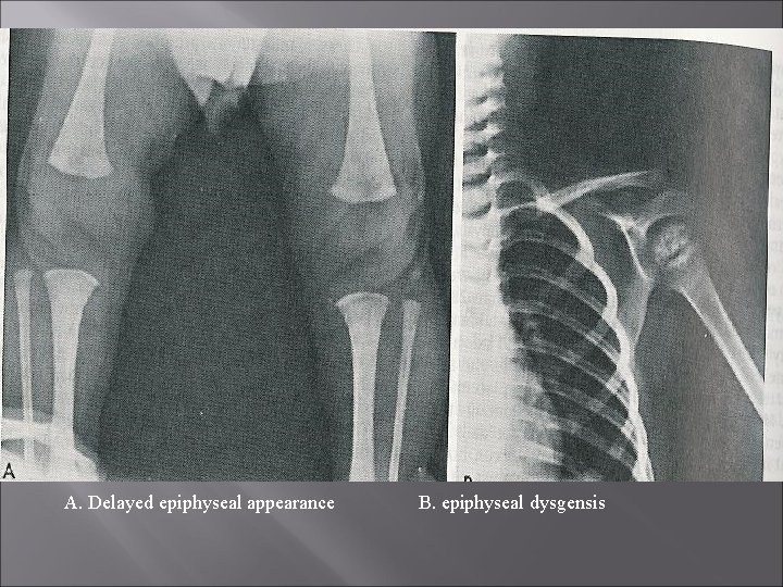A. Delayed epiphyseal appearance B. epiphyseal dysgensis 