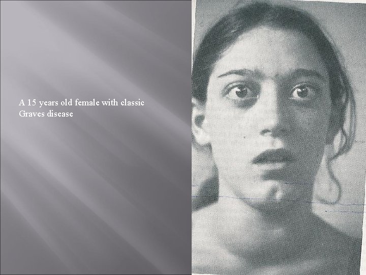 A 15 years old female with classic Graves disease 