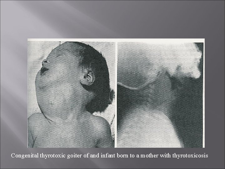 Congenital thyrotoxic goiter of and infant born to a mother with thyrotoxicosis 