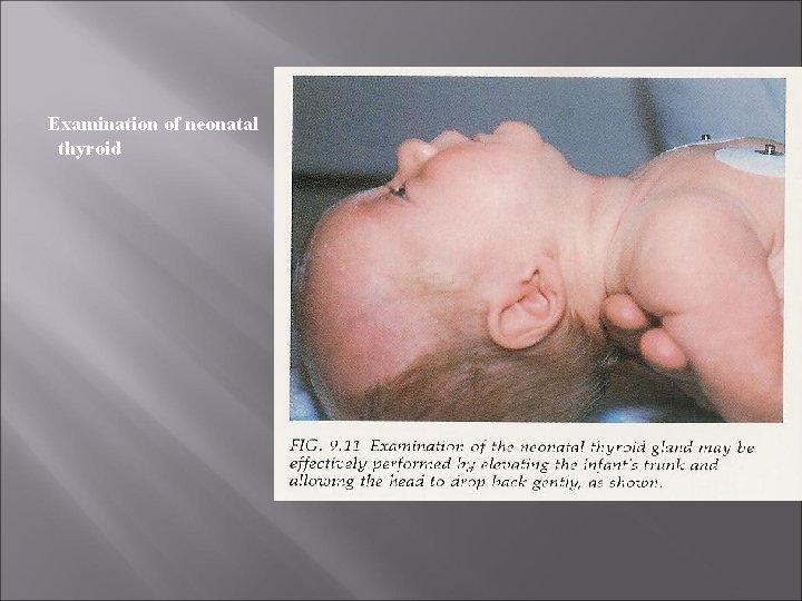 Examination of neonatal thyroid 
