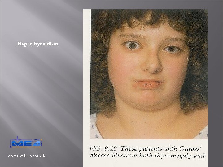 Hyperthyroidism www. medkaau. com/vb 