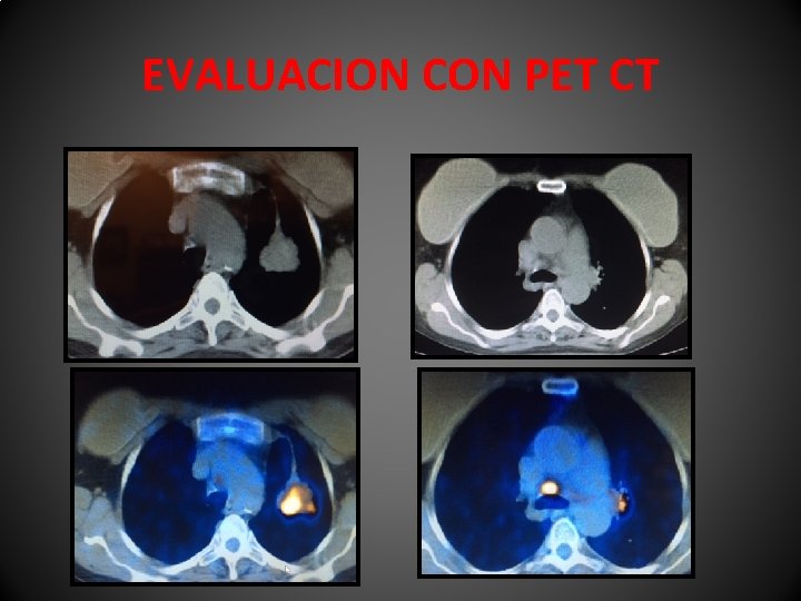 EVALUACION CON PET CT 