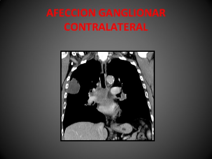 AFECCION GANGLIONAR CONTRALATERAL 