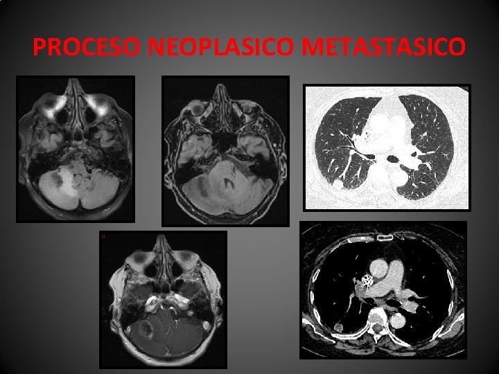 PROCESO NEOPLASICO METASTASICO 