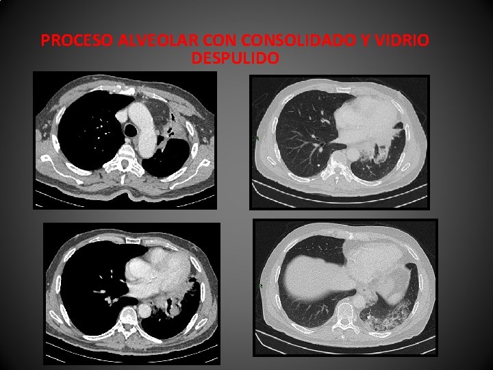 PROCESO ALVEOLAR CONSOLIDADO Y VIDRIO DESPULIDO 