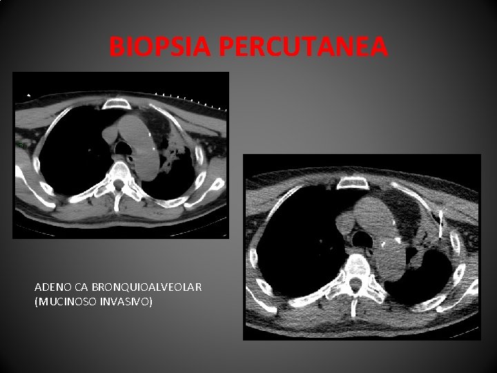 BIOPSIA PERCUTANEA ADENO CA BRONQUIOALVEOLAR (MUCINOSO INVASIVO) 