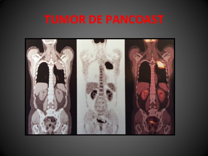 TUMOR DE PANCOAST 