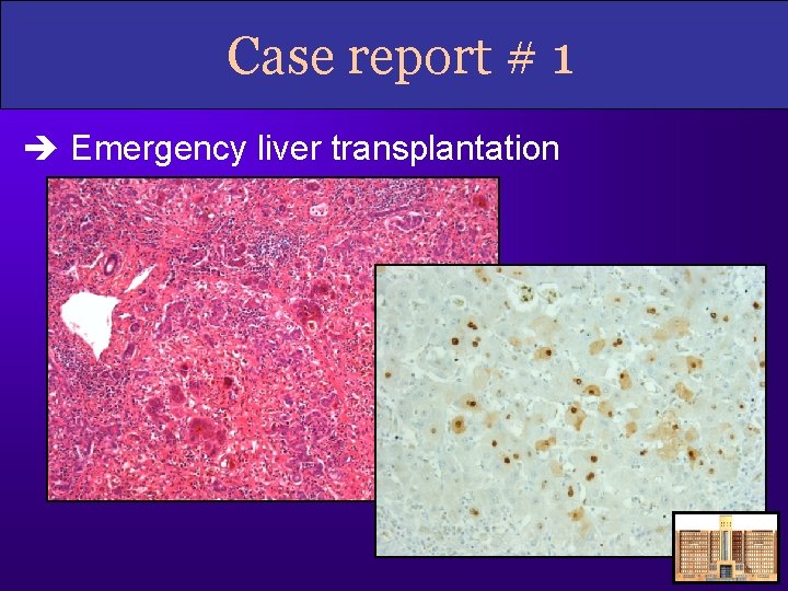 Case report # 1 Emergency liver transplantation 