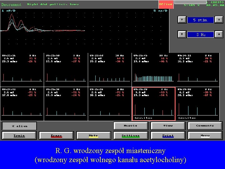 R. G. wrodzony zespół miasteniczny (wrodzony zespół wolnego kanału acetylocholiny) 