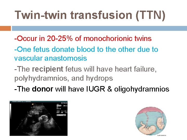 Twin-twin transfusion (TTN) -Occur in 20 -25% of monochorionic twins -One fetus donate blood