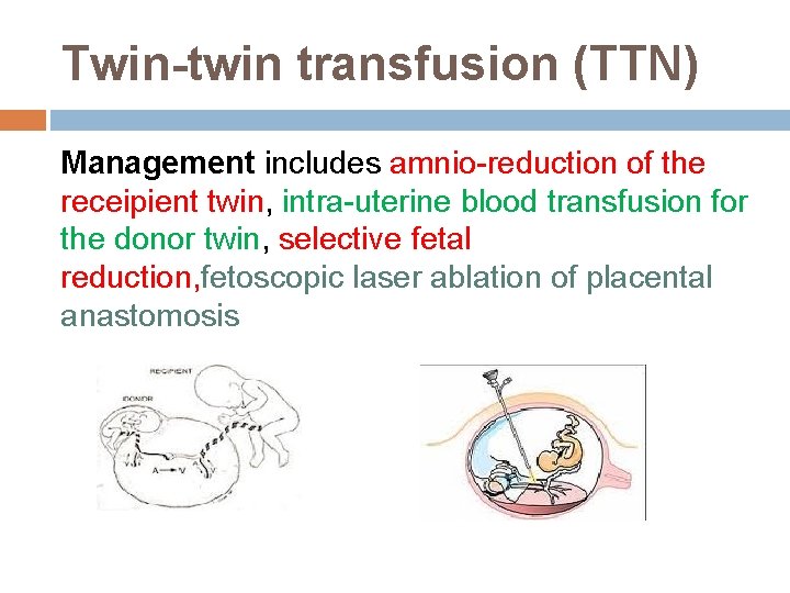 Twin-twin transfusion (TTN) Management includes amnio-reduction of the receipient twin, intra-uterine blood transfusion for