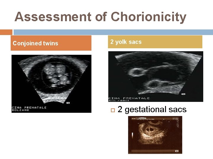 Assessment of Chorionicity Conjoined twins 2 yolk sacs 2 gestational sacs 