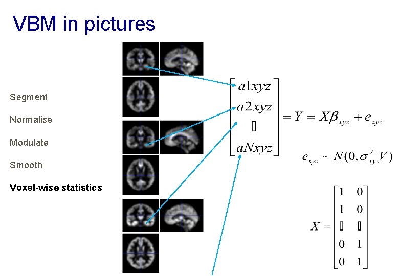 VBM in pictures Segment Normalise Modulate Smooth Voxel-wise statistics 