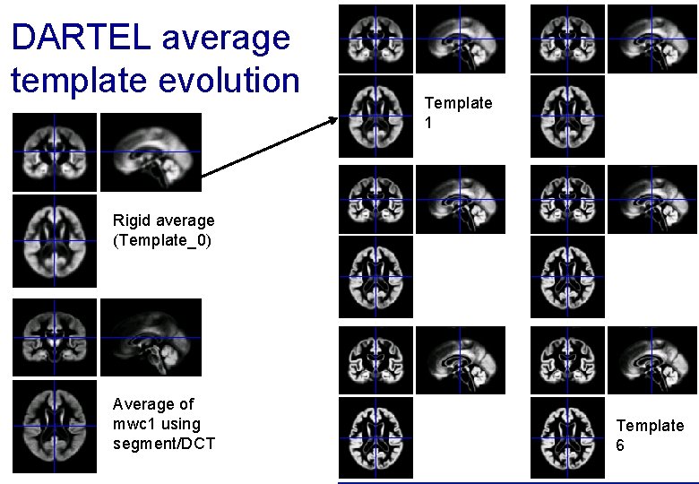 DARTEL average template evolution Template 1 Rigid average (Template_0) Average of mwc 1 using