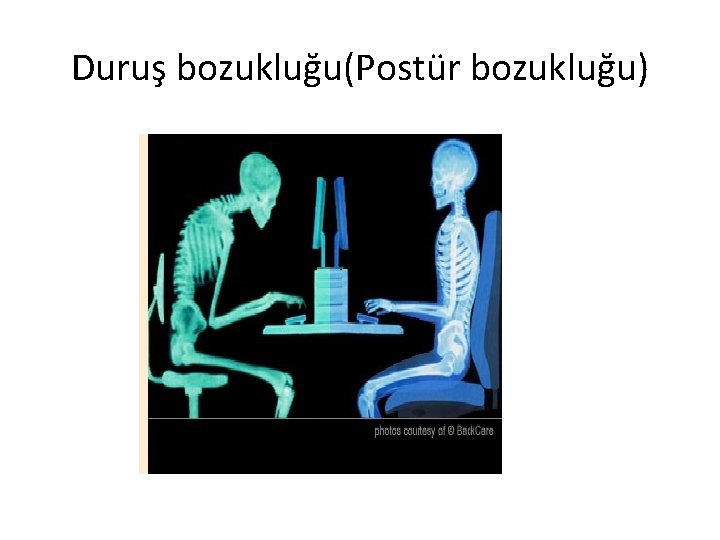 Duruş bozukluğu(Postür bozukluğu) 