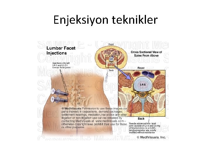 Enjeksiyon teknikler 