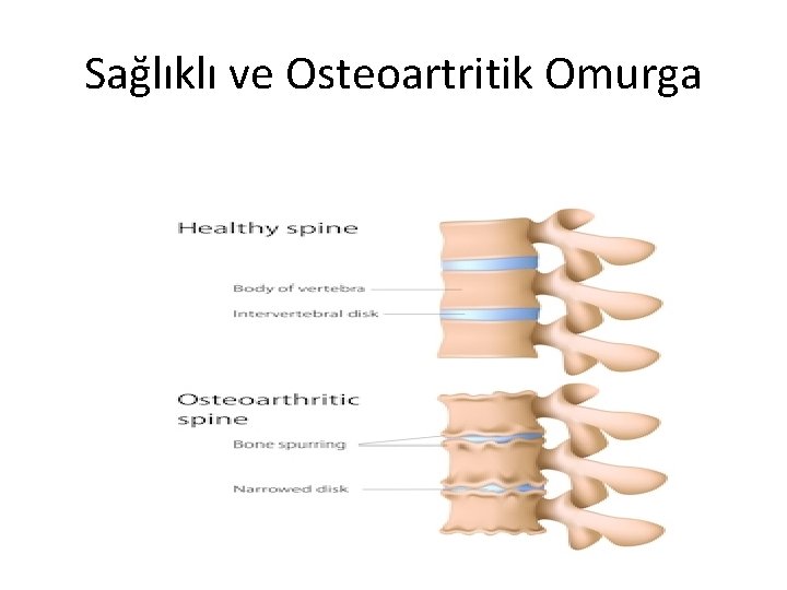 Sağlıklı ve Osteoartritik Omurga 