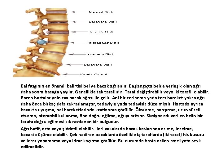 Bel fıtığının en önemli belirtisi bel ve bacak ağrısıdır. Başlangıçta belde yerleşik olan ağrı