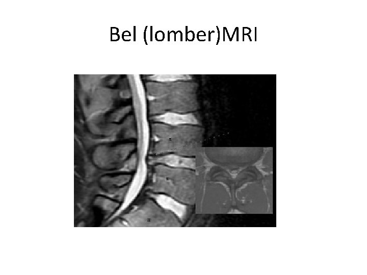 Bel (lomber)MRI 